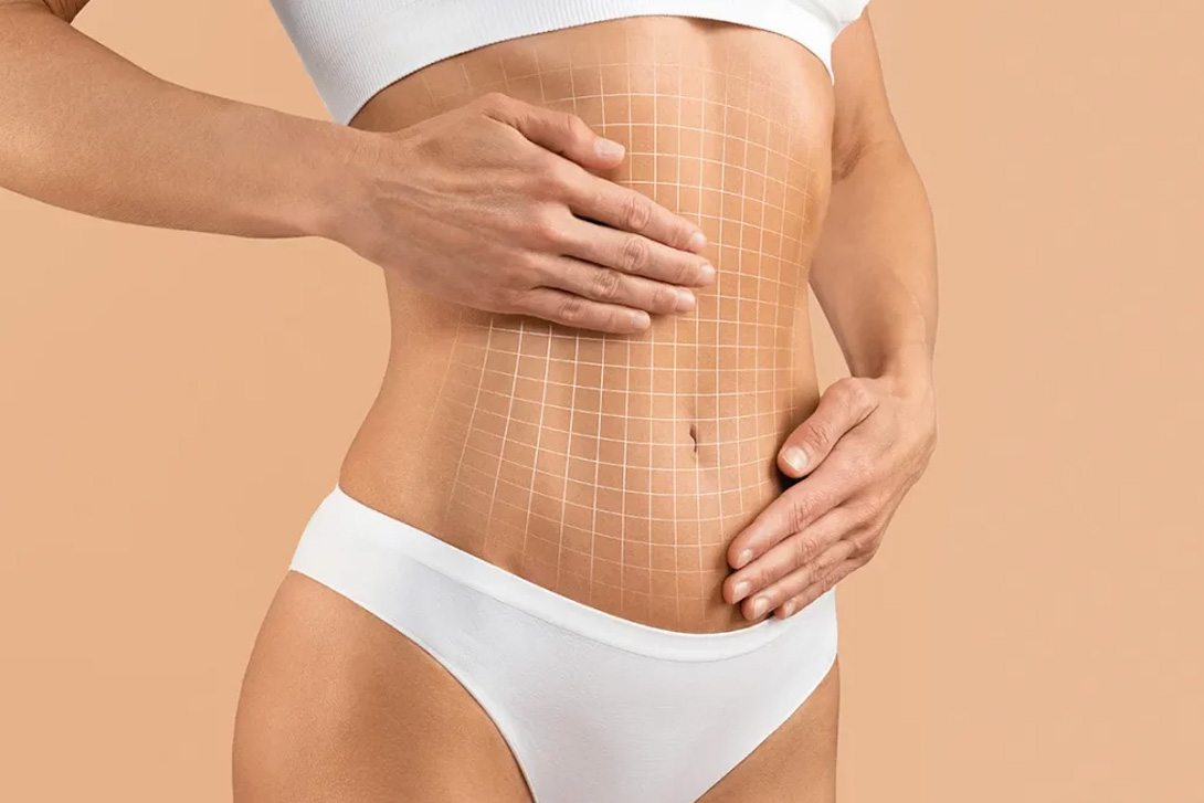 Révélez silhouette abdominoplastie