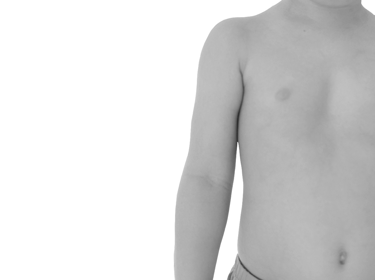 Lipomodelage pectus excavatum