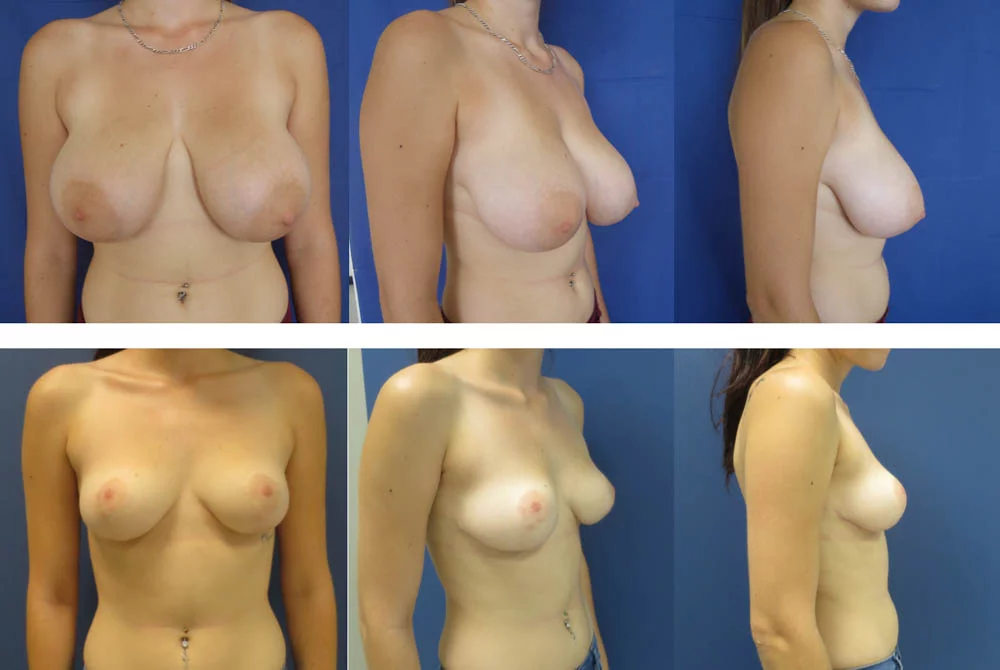 Réduction mammaire - Patiente 1