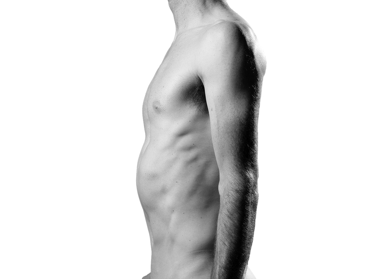 Pectus excavatum