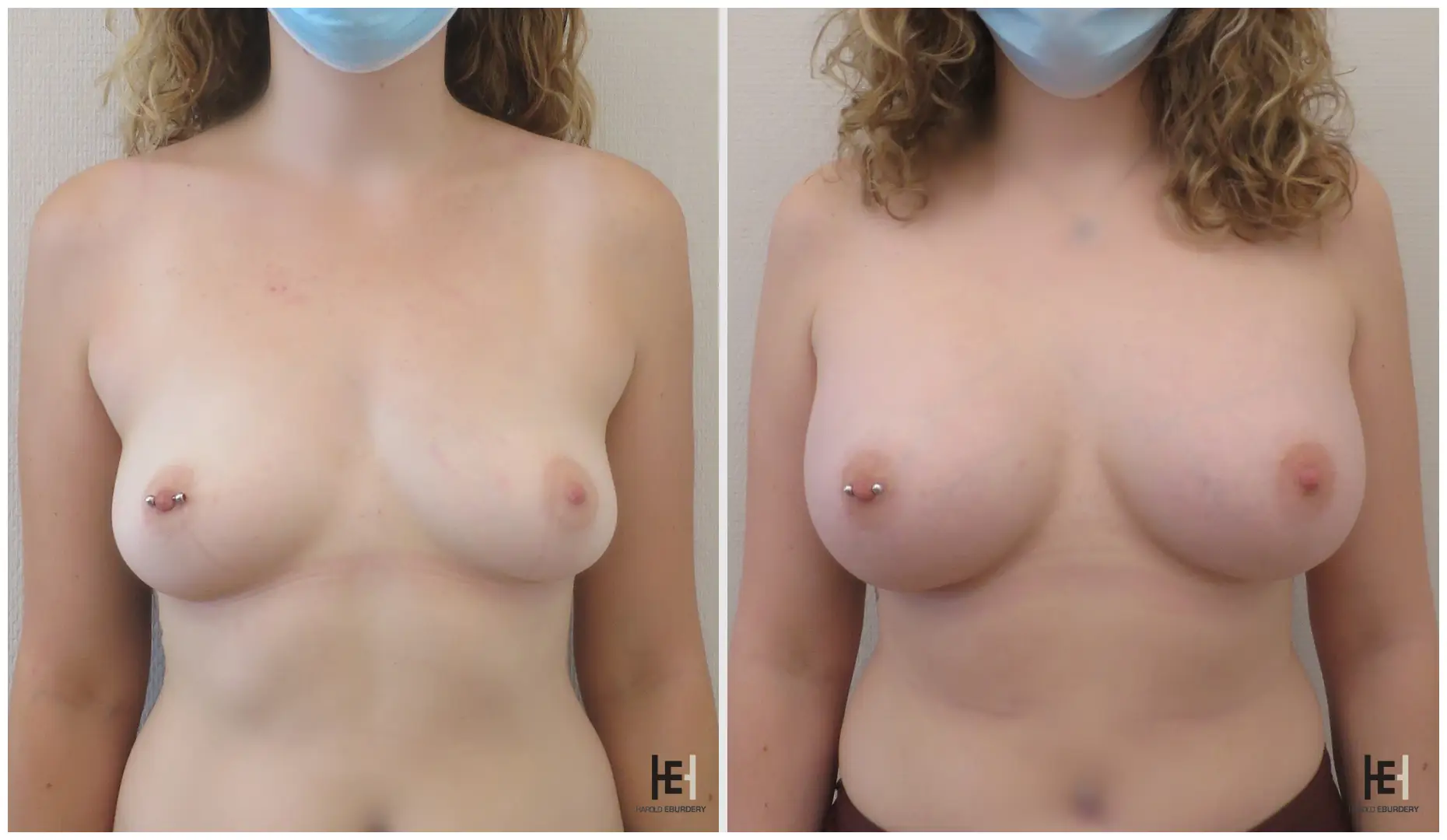 Prothèse mammaire - bonnet B 425cc face