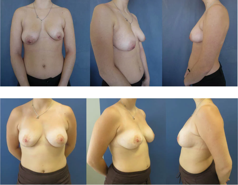 Seins tubéreux - Patiente 1