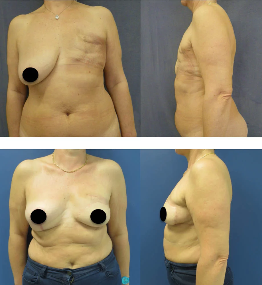 Reconstruction mammaire par lambeau - Patiente 1