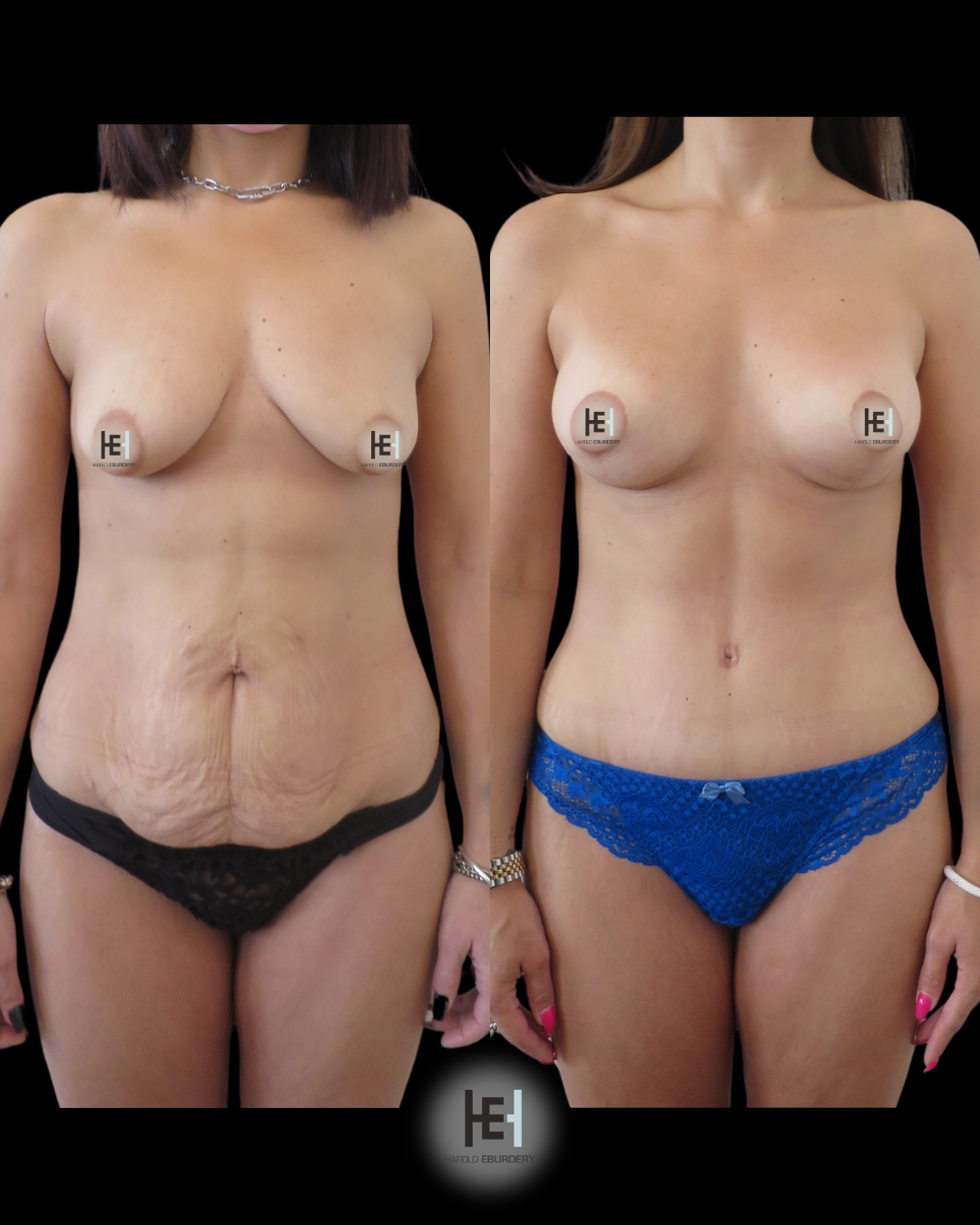 Photos avant / après abdominoplastie