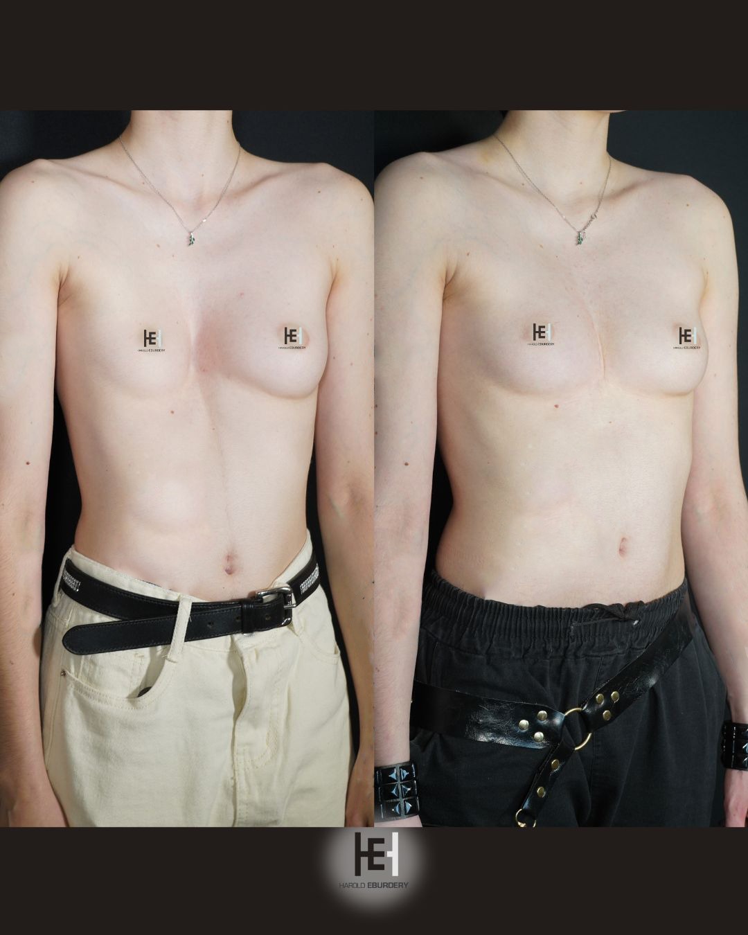 Photos - Pectus - Patient 6