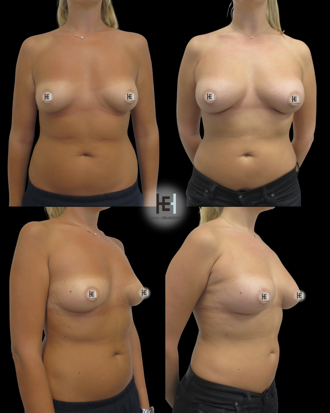 lipomodelage mammaire  - Patient 1