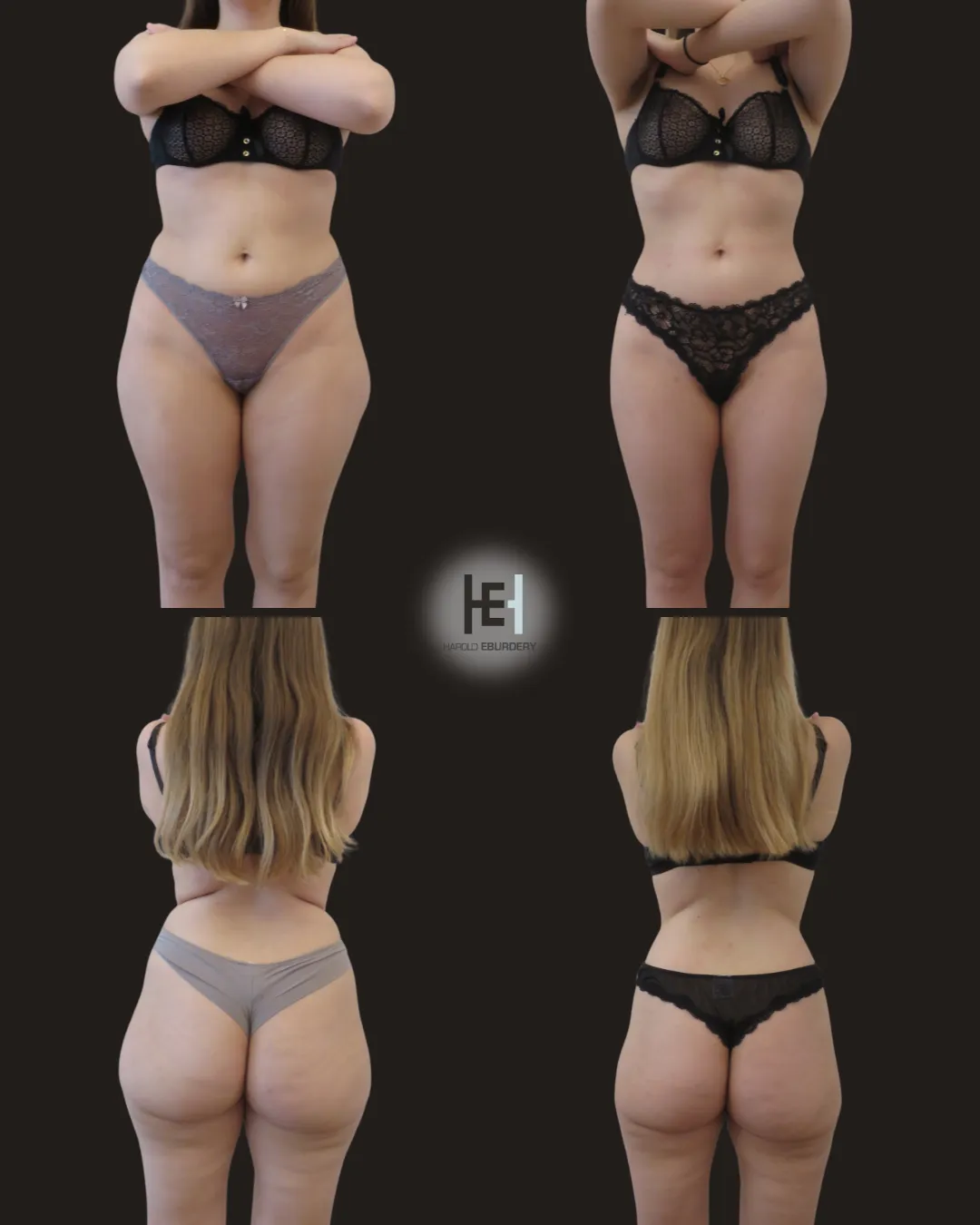 liposuccion  - Patient 1