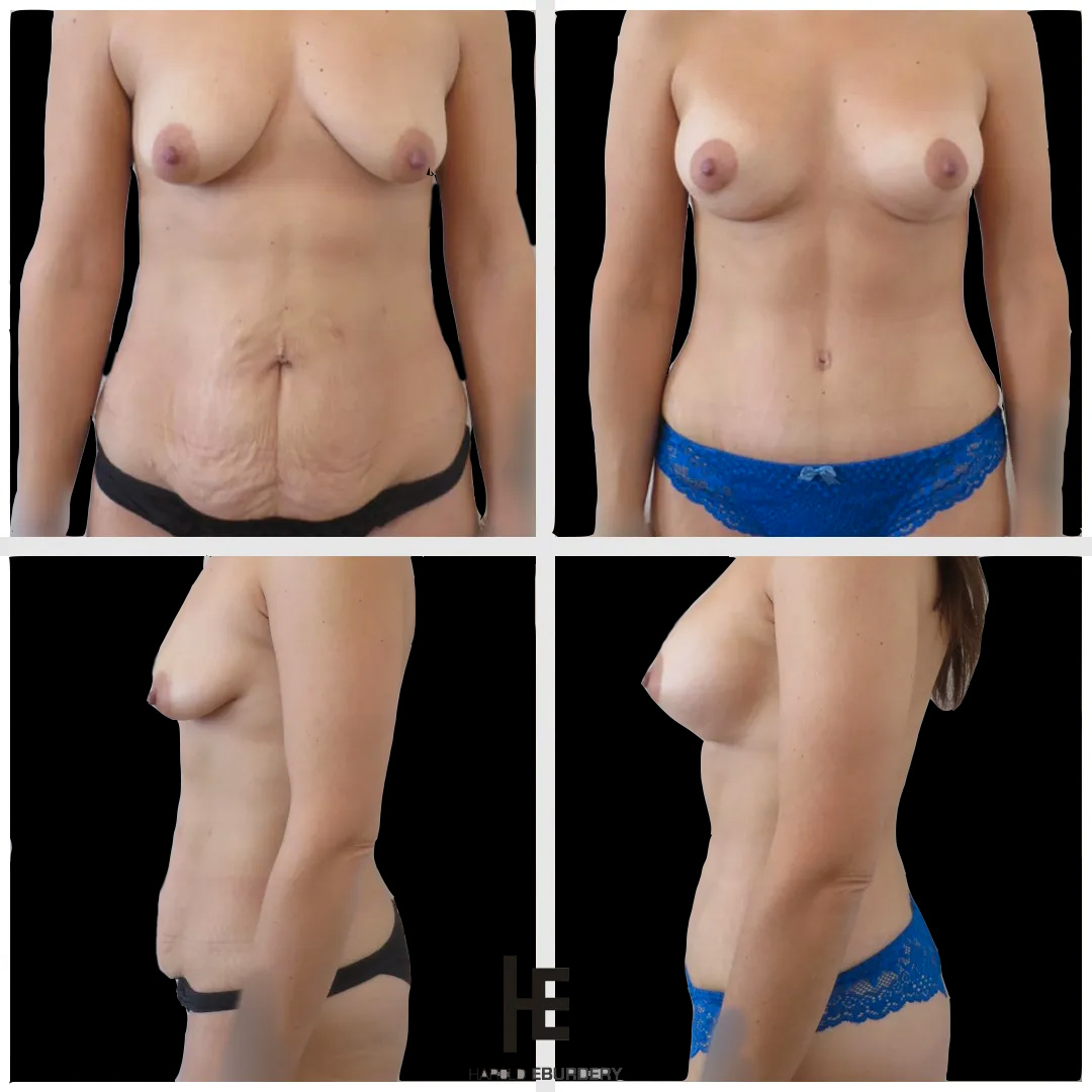 mommy makeover - Patient 3