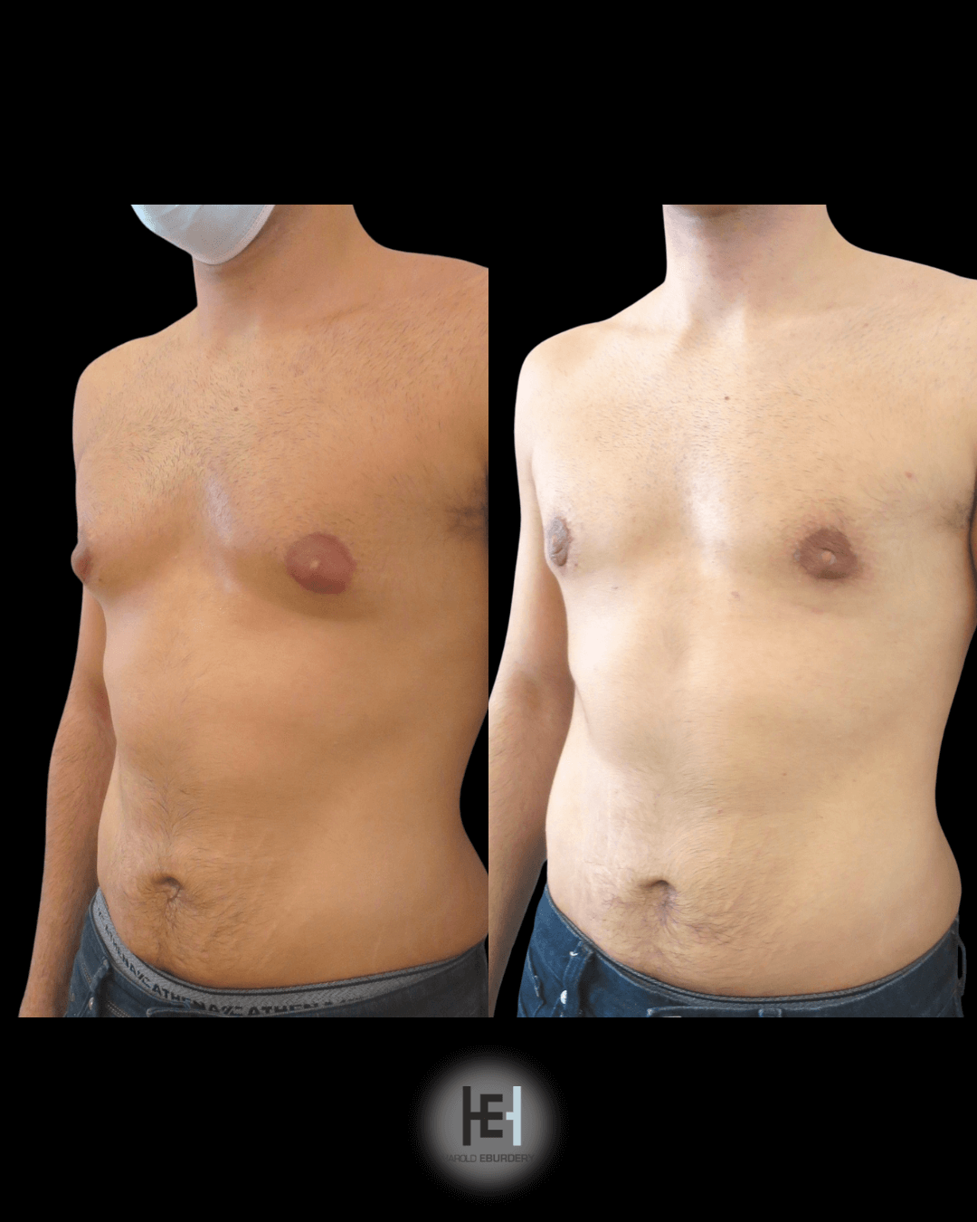 Gynécomastie - Patient 1