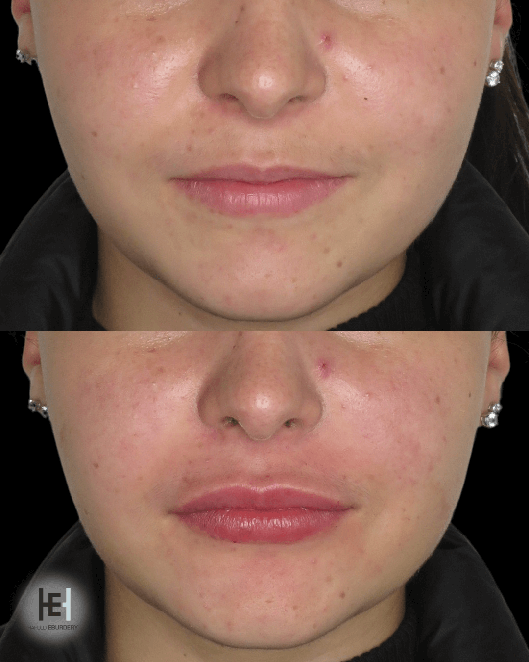 acide hyaluronique - Patiente 1 face