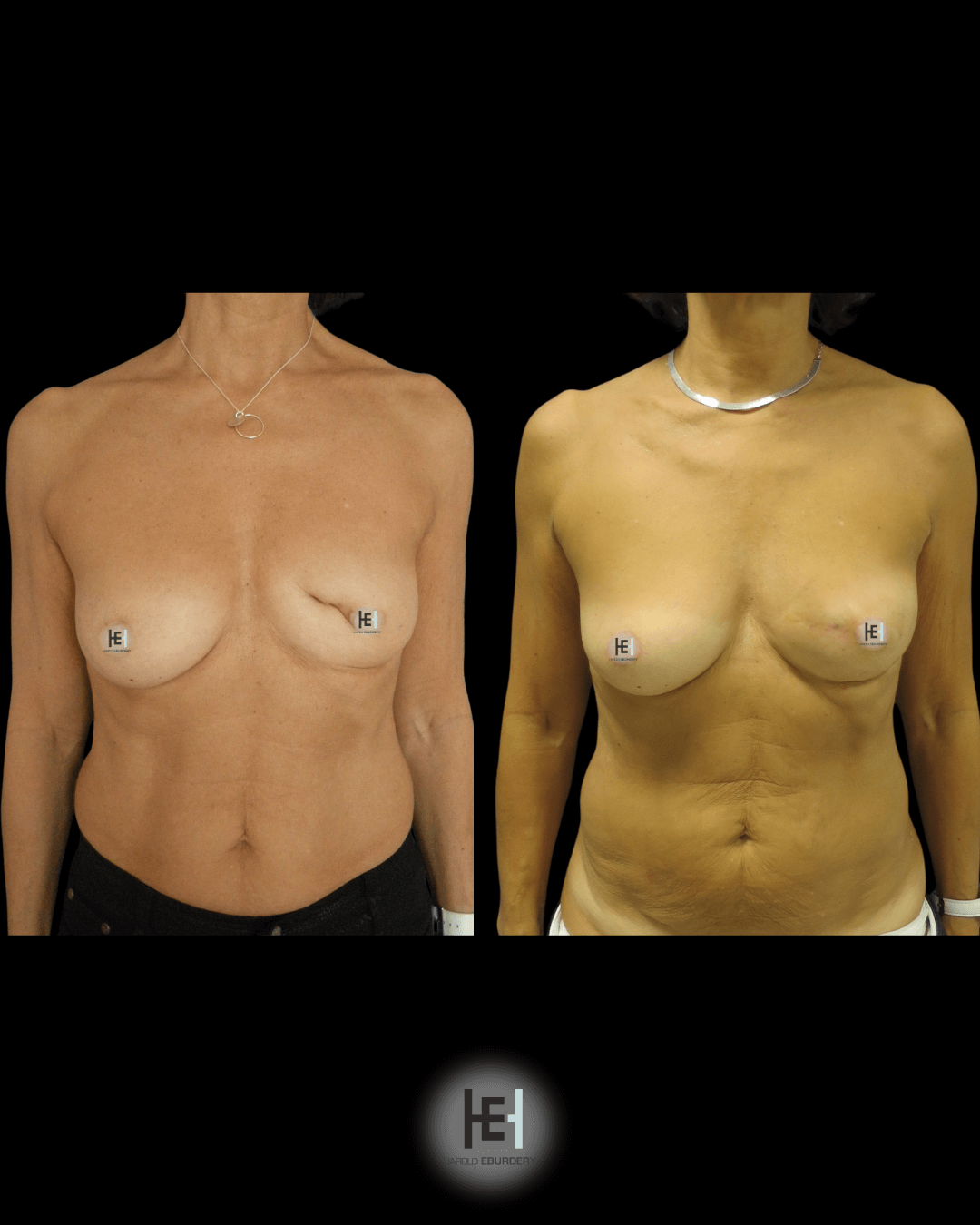 Reconstruction mammaire par lipomodelage - Patiente 1