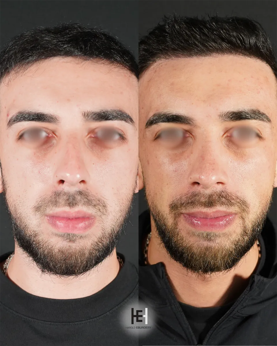 Photos - Rhinoplastie - Patiente  6 face