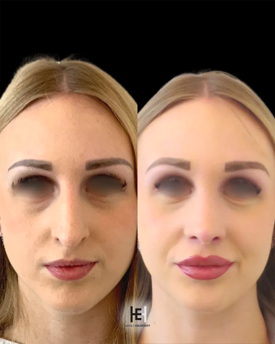 Rhinoplastie préservation - Patiente 3 face