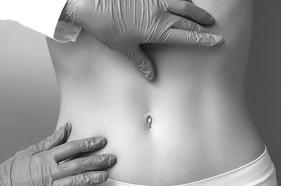 Abdominoplastie