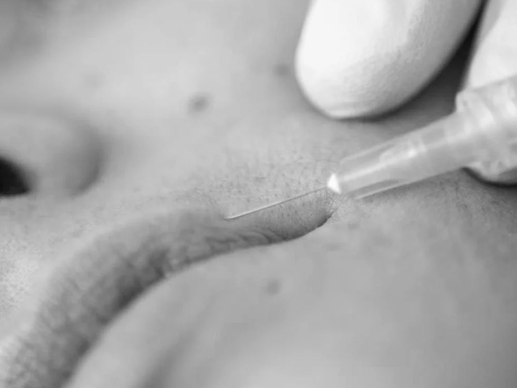 Injection acide hyaluronique levre