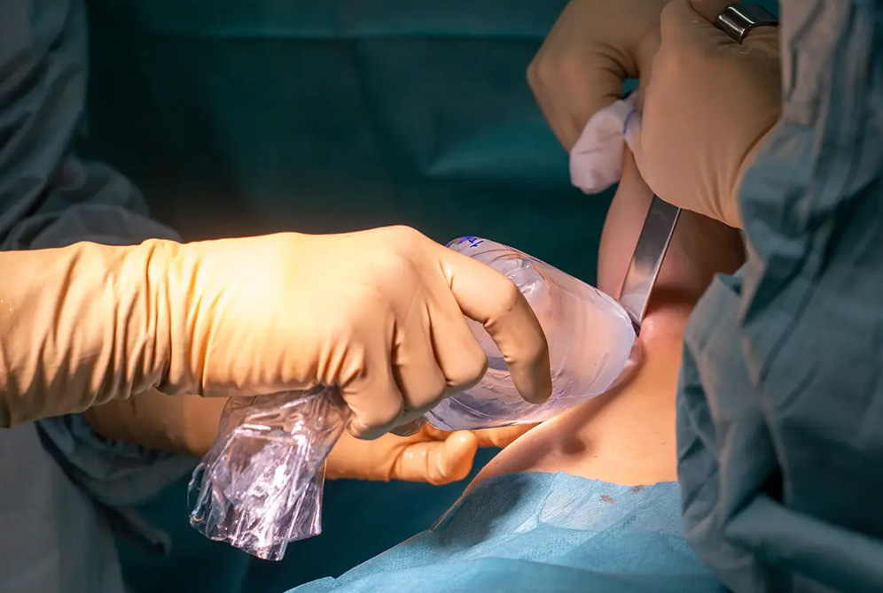 Lipofilling mammaire