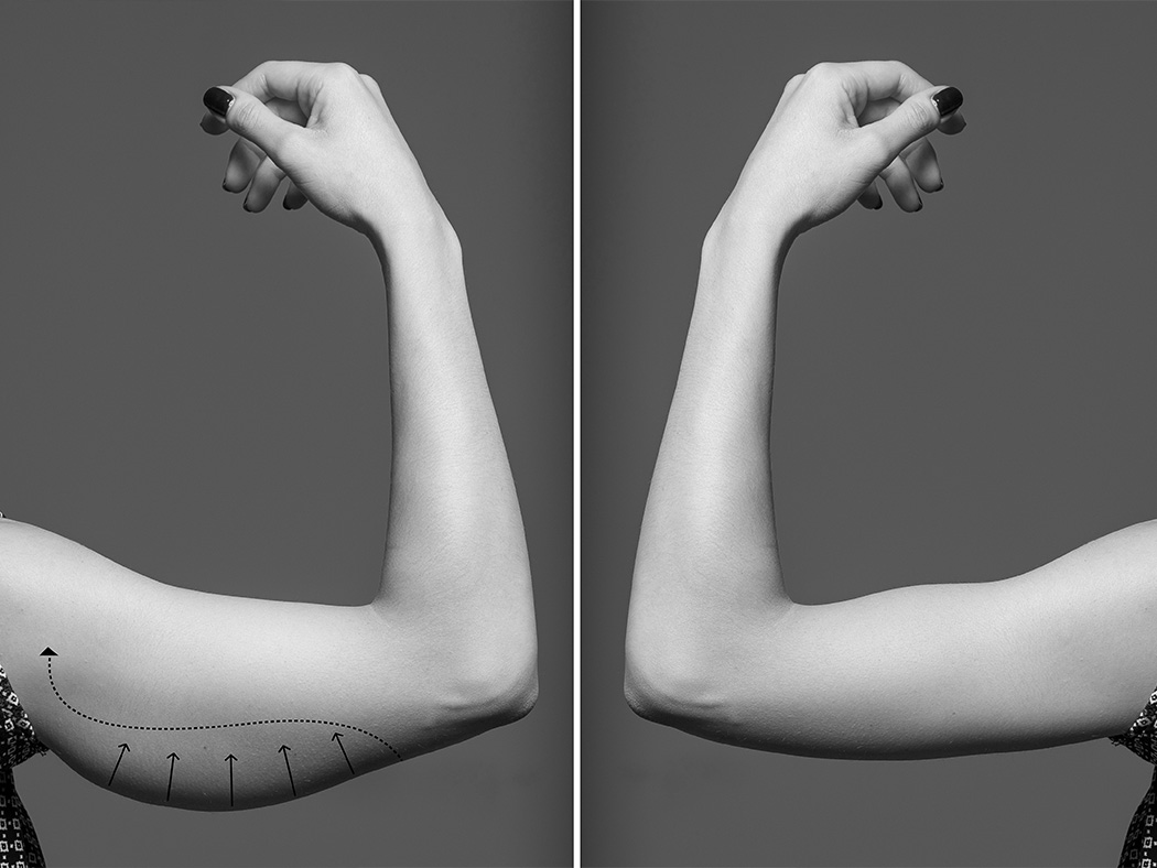 Résultats brachioplastie